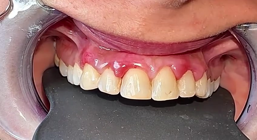 ابتسامة الحشوات الضوئية, التهاب اللثة, المعالجة بالليزر.

عيادة د.عمار عزيز لطيف 👨‍⚕️💗
بغداد / رحمانية الشعله / عمارة الوليد 
للإستفسار الاتصال على 
***********
***********
واتس اب https://wa.me/9647777495690
