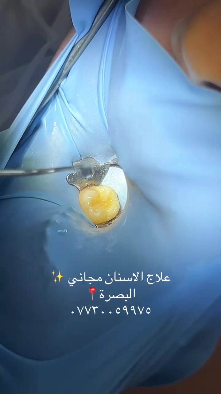 نستقبل المراجعين لعلاج الاسنان مجاناً ❣️
الحشوات الضوئية وحشوات الجذور
تنظيف الاسنان وازالة التكلسات
قلع الاسنان التالفة والجذور 
تعويض الاسنان المفقودة 
معالجة اسنان الاطفال(حشوات،قلع،تنظيف)
جلسة الفلورايد للاطفال لحماية الاسنان وتقليل التسوسات
تقويم الاسنان للاطفال
البصرة_***********
