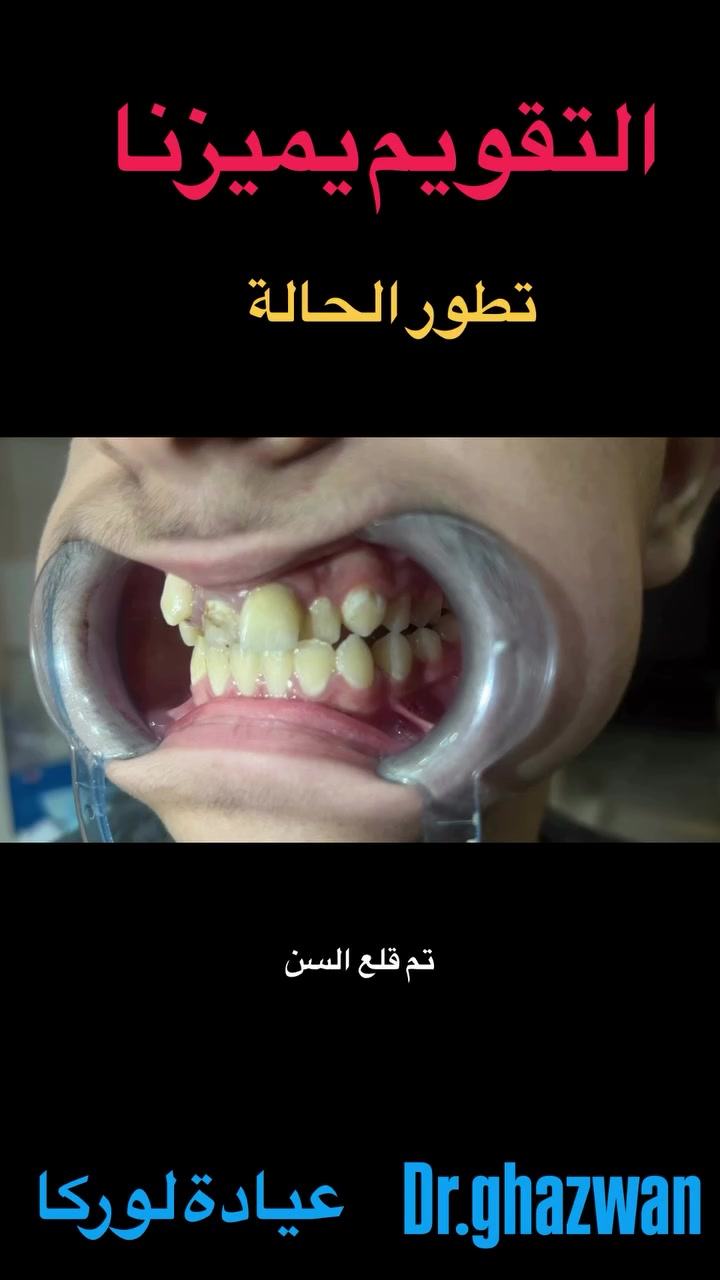التقويم يميزنا احد اعقد و اصعب الحالات في تحديد او خطة العلاج و قرار قلع الاسنان حيث كانت من الحالات تحتاج وقت في دراسة خطط العلاج… علاج جميع الحالات الصعبة و المعقدة نتائج مضمونة خبرة طويلة في مجال الحالات المعقدة اسعار مناسبة بالتقسيط المريح… دكتور غزوان مزهر بغداد الكرخ نفق الشرطة بداية شارع الاطباء عيادة لوركا فوق صيدلية كنز النفق متوفر واتس *********** #تقدمالفكالسفلي #تقويم_الأسنان_بأنواعه #العضة_المعكوسة #تقدم_الفك_العلوي_السفلي #تقويم_الأسنان_والفكين @حشوات_الاسنان @زراعة_الاسنان
