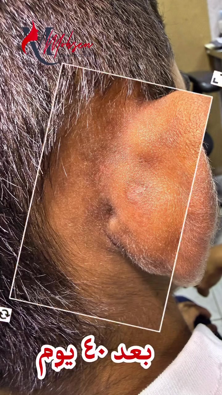 عيادة الامراض الجلديه والتجميل                 
                  الدكتور محمد محسن        
      اختصاصي الامراض الجلديه والتناسليه.                               #دكتوراه(بورد عربي).  
 #Mohamed Mohsen, MD l
اختصاص جراحةوتجميل الجلد   والليزر-بلازما-ميزو-تقشير كيميائي-بوتكس. 
#دبلوم عالي تخصص دقيق في تطبيقات الليزر الطبيه والبايلوجيه.
الرمادي -شارع الاطباء-مجاور صيدلية ابن سيناء-للحجز-***********
