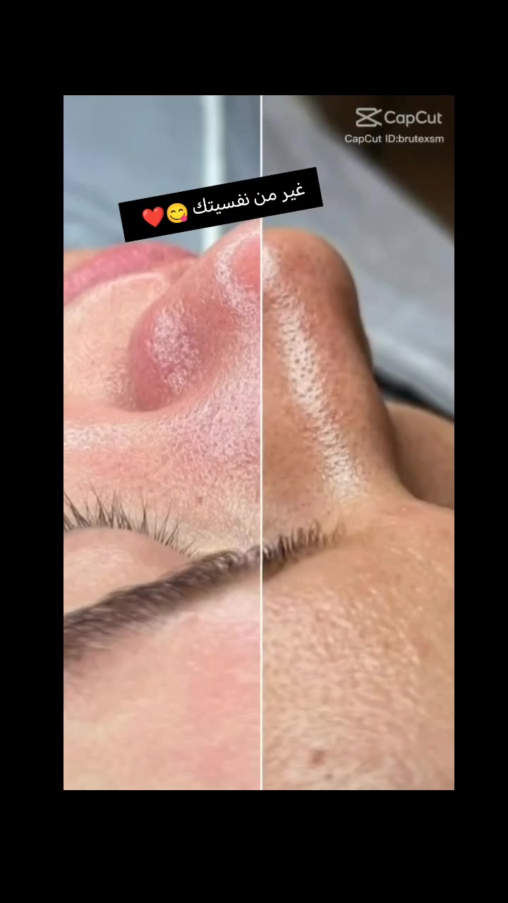 عرض تنظيف البشره احجز جلستك
الحجز ع وتساب
📍  العنوان: [حي العدل شارع الاسواق /مجاور لحوم رسول العنبر]
📞 للحجز والاستفسار: [***********]
📲 تواصلوا معنا عبر الواتساب: [***********]
جمالكِ يستحق الرعاية الأفضل.. بانتظار زيارتكِ!
