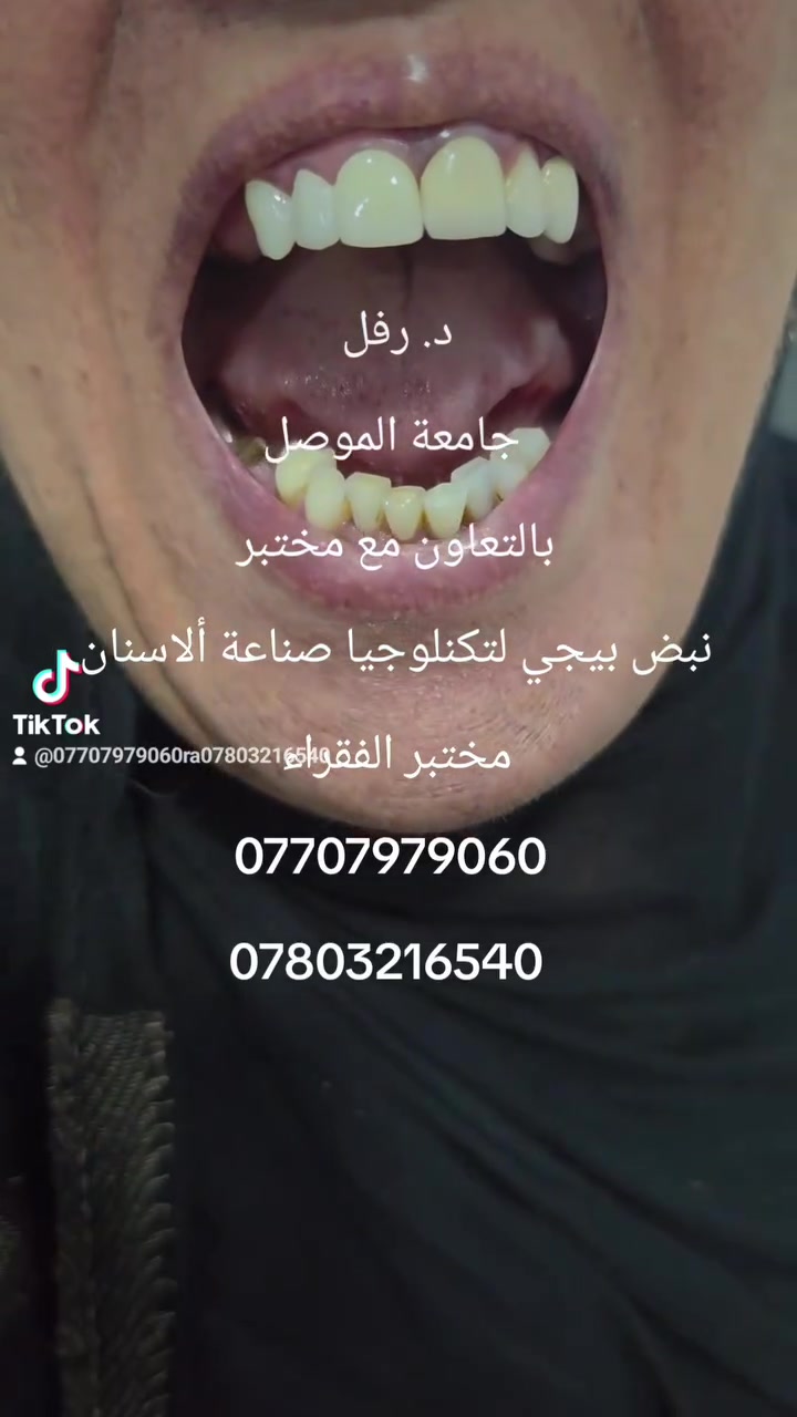 @أبرز المعجبين 
عندما نختار الطبيب الصح تكون هكذا النتيجة 
الدكتورة رفل كامل محمود جامعة الموصل 
بالتعاون مع مختبر نبض بيجي لتكنلوجيا صناعة ألاسنان
مختبر الفقراء 
ابتسم معنا 
***********
***********
