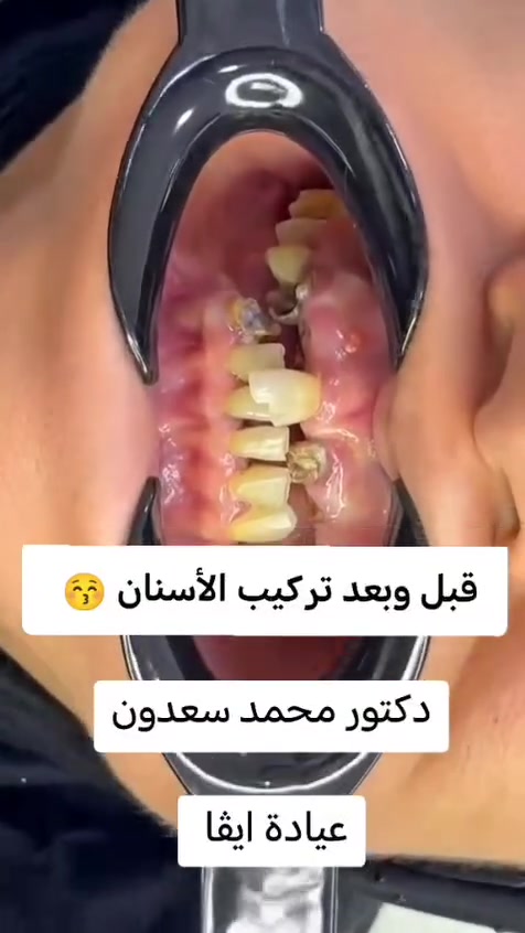 حشوه ضوئية تجميليه ب25 ألف
75 ألف تركيب الزاركون الألماني المدمج بالايماكس 
55 ألف تركيب السيراميك الألماني 
تقويم الاسنان بالتقسيط المريح 
زراعة الأسنان 

فحص ومعاينة مجاني يوميا مع اشعه للاسنان ☺️

عيادة ايفا للتجميل والأسنان 💉🦷
دكتور محمد سعدون 

العنوان #مدينة الصدر الكياره قطاع٦٧ مقابل نادي الجولان

‏‪***********‬‏📞
