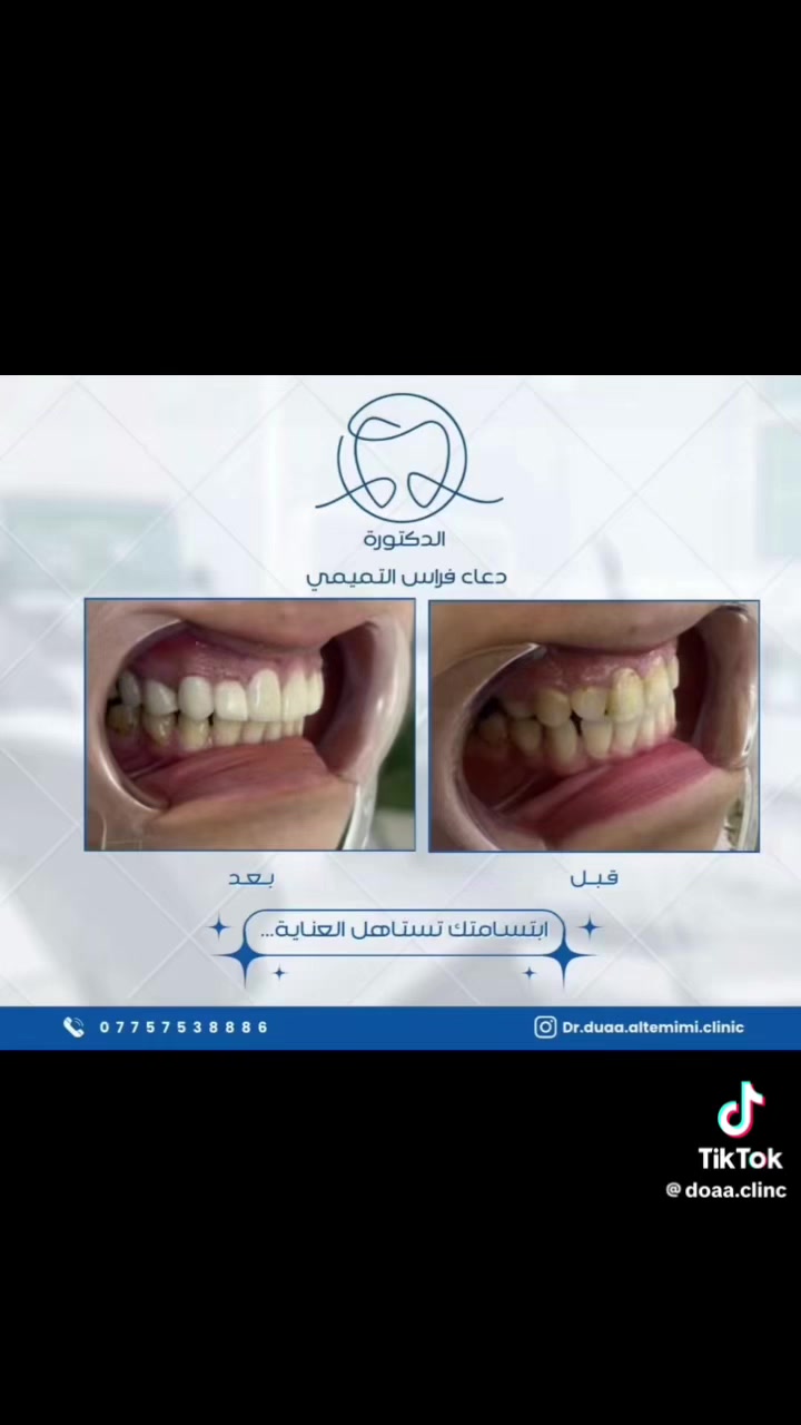 🦷عيادة الدكتورة دعاء فراس التميمي 🦷
-لعلاج الاسنان بالتقويم الشفاف والمعدني 
-زراعة الاسنان وعمل التراكيب السنية بالزاركون والسيراميك 
-عمل الحشوات التجميلية وحشوات الجذور 
-تنظيف وتبيض الاسنان بالليزر 

📍الكمالية - شارع الجامع  - مقابيل مثلجات الفريداوي 

🕠اوقات الدوام من الساعة 4 الى 2بعد منتصف الليل  جميع ايام الاسبوع 

📞للحجز والاستفسار :

***********
