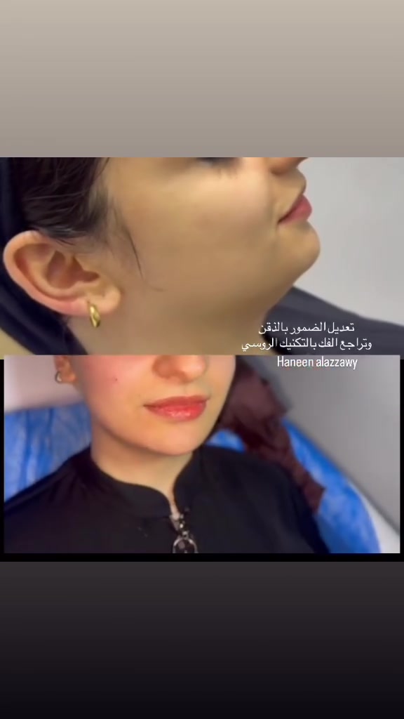 لمن يكون الحقن بأيادي خبرتها سنوات وبمواد براند  مو مثل الحقن بأيادي مبتدئين
ولأن  دكتورتنا تحب تدللكم🤍 تختارلكم افضل المواد بتكنيكات متنوعة ومعروفين احنة بالتكنيك الروسي لاول مرة بالعراق  وبارخص الاسعار 
ولان الدكتورة مدللتكم مددت العروض الى يوم 5 حتى كل الكيكات يستفادون سواء كانو طالبات او عروسات جدد 
للاستفسار راسلو صفحتها 
او ثبتو حجوزاتكم مباشرة واتساب  على الرقم
  ‭***********‬ 
Haneen Alazzawy
