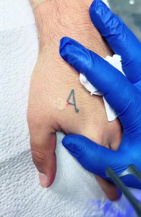 وصول جهاز ازاله وشم
كلا الجنسين 
جهاز اندياك  ليزر ND-YAG Laser (Q-Switch)  
  يعمل على 
🔸️ازالة الوشم بجميع انواعه (الغامق والفاتح) 
🔹️التقشير الكاربوني
🔸️ازالة الكلف و التصبغات من البشرة
🔹️أزالة مايكروبليدنج و تاتو الحواجب
🔸️ ازالة اثار الجروح والحروق
▫️لايؤذي الجلد و بدون ألم او حروق 
▫️لايحتاج الى تخدير اثناء الجلسة  
▫️سهولة الإستخدام 
للحجز والاستفسار
كوافير علي ***********
