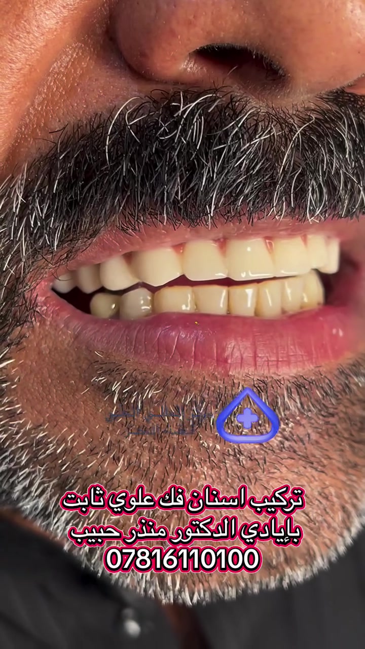 أجعل ابتسامتك افضل مع
 الدكتور الماهر منذر حبيب

📍متواجد طيلة أيام الاسبوع 

من الساعة 8:00 صباحاً حتى الساعة 12:00 ظهراً
ومن الساعة 3:00ظهراً حتى الساعة 9:00 ليلاً 

📍موقعنا : الناصرية قضاء النصر الصوب الكبير الفرع المقابل مصرف الرافدين

📲للحجز والاستفسار الاتصال
 على رقم قسم الأسنان ***********
