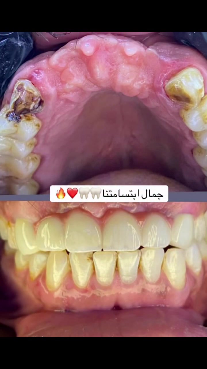 تركيب اسنان ثابتة لمراجعنا🦷❤️

📌استخدام الطبعه الرقمية بدل الطبعه التقليدية 
📌تعامل مع أرقى المختبرات لصنع الاسنان 
📌 أسعار مناسبة 
📌 سرعه الشغل وجماله
-----------------❤️---------------❤️------
الحله/ حي الامام علي/ بدايه شارع الكابينات /مقابل كرار ابو الكص 
علما بأن العياده تعمل بنظام الحجز المسبق فقط
سارعوا بالحجزواتساب ***********
