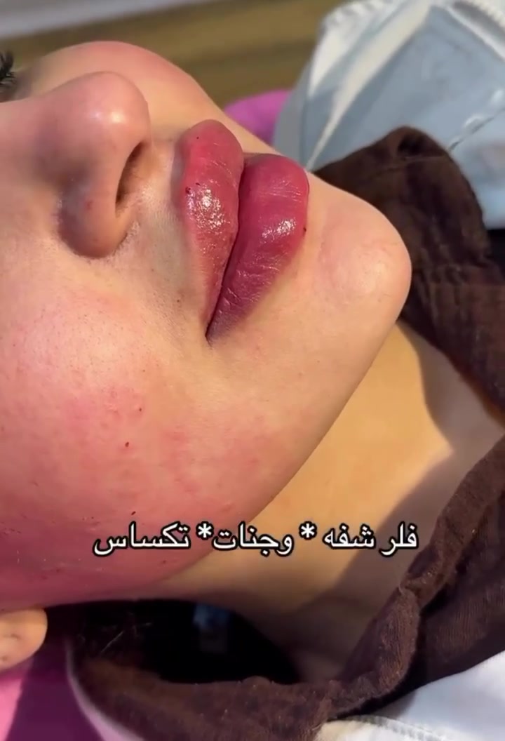 يسرنا ويسعدنا بحضوركم لافتتاح مركز ريم بيوتي المصادف يوم السبت 🩷 
عروض 50% بمناسبة افتتاح المركز على الأقسام التالية: 
قسم الليزر 
قسم الحقن والنظارة
قسم الشعر 
قسم البدكير والاظافر 
وحتى قسم المكياج 🩷 
نورونا داخل المركز وحصلوا على عروض اضافية گ اول زبائن 
العنوان بغداد جكوك الاستدارة الاولى مقابل صاحب ماركت فوق صيدلية الغيمة المركزية 
للحجز والاستفسار ***********

بروتين للشعر + تريتمنت + شسوار ٢٥ 
معالج الشعر الذهبي الحريري + شسوار ٢٥ 
تبييض مناطق حساسة سعر الجلسة ٣٠ 
بكج تقشير الجاف+ حمام حرير+مساج ٤٠ 
جل اكستينشن + تنظيف بشرة عميق + جلش ٤٠ 
جلش+سترونك+ تنظيف بشرة + رموش كلاسك ٥٠ 
بدكير + منكير + جل اكستينشن + جلش ٣٥

قسم الليزر المعاينة مجانية🩵
ليزر توتل بدي ٨٥ 
( يشمل كل الجسم) 
ليزر فل بدي ٦٠
(عدا الوجه، ظهر، بطن)
ليزر ميني بدي ٥٠
(نصف ذراع، نصف ساق،بكيني،أندر ارم،شارب)
الجزء الواحد ٢٠ 
بكيني + أندر ارم ٣٠ 
تحديد لحية ٢٥ 
عند قطع ٣ جلسات الجلسة الرابعة مجاناً 

5 جلسات ليزر توتل بدي 350 بدل 450 
5 جلسات فل بدي 230 بدل 325
5 جلسات ميني بدي 175 بدل 250 
5 جلسات بكيني + أندر ارم 95 بدل 150

