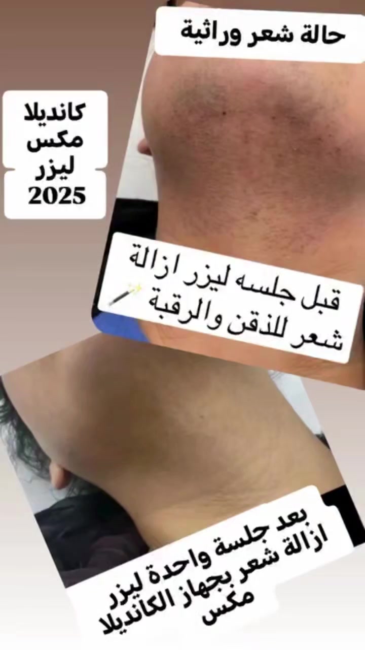 شعر هرموني • كانديلا مكس • إزالة بالليزر