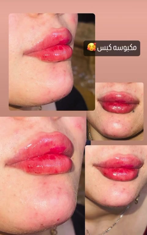 ✨ ايليا ابيوتي ✨
🎉 عرض 50% لفترة محدودة 🎉
فيلر شفه • خدود • نضارة • تكساس

بأيدي ألاخصائية ايليا 
للحجز: ***********
العنوان: بغداد - حي سومر - شارع المدارس - ظهر مستشفى الشعبي
تيك توك: frwlh2003@
