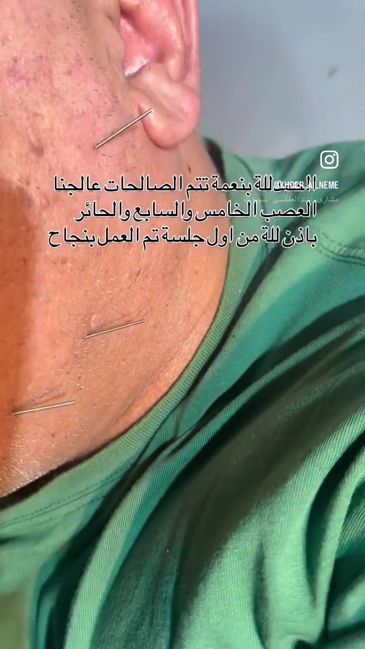 عالجنا اليوم عصب الخامس والسابع مسبب ثقل بالنطق وكهرباء في العصب عند الكلام العنوان العامرية الجمعية المعالج الفيزيائي خضر النعيمي هـ ***********
