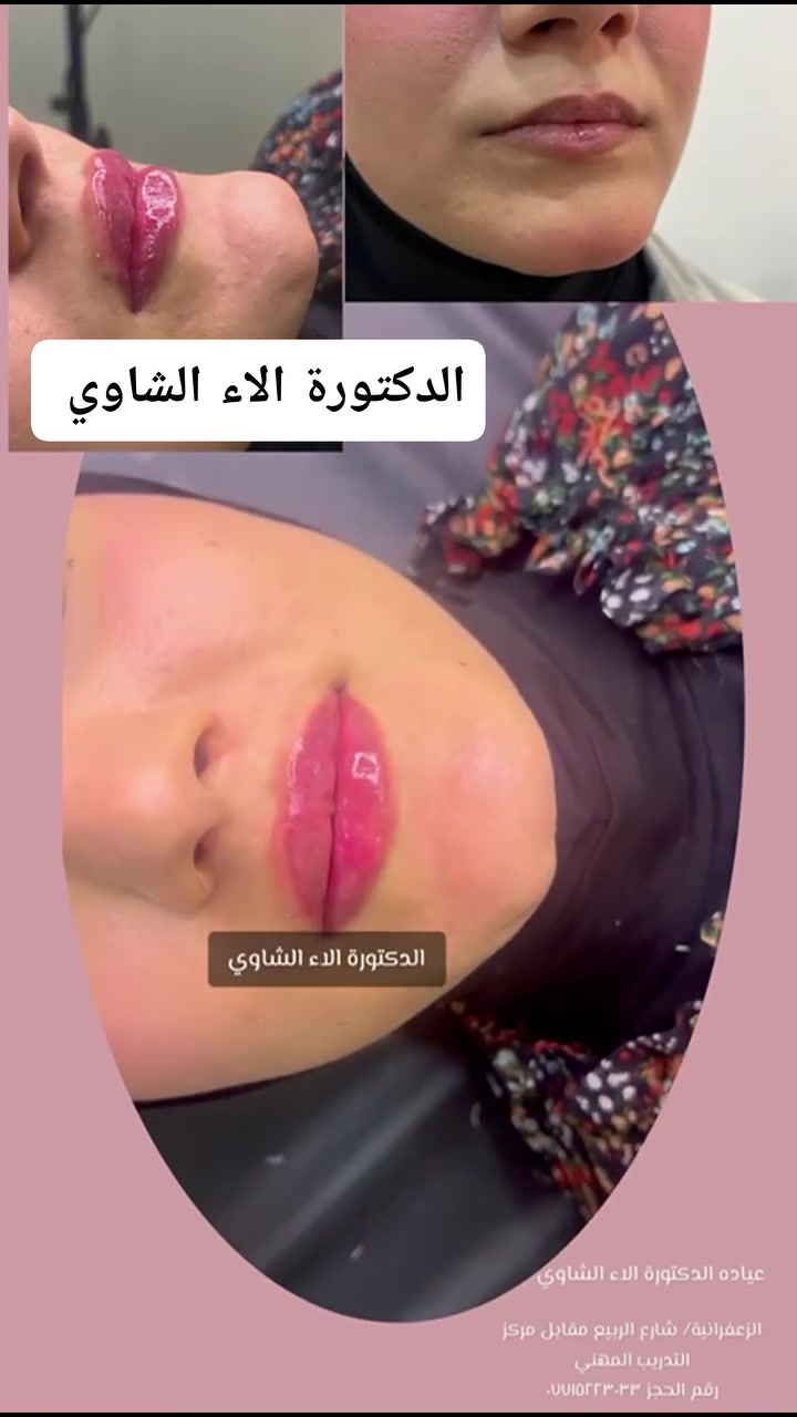 💋 فلر الشفاه… لمسة ناعمة لشفاه أكثر تحديداً وتناسقاً ✨
امتلاء طبيعي، ترطيب ومظهر أجمل بدون مبالغة 🤍

📩 للحجز والاستفسار: راسلينا الآن واحجزي موعدچ

📍 بغداد – الزعفرانية شارع الربيع مقابل مركز التدريب المهني 
📞 ***********
