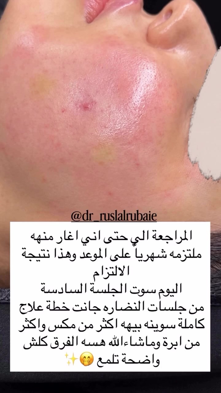 فيلر شفايف • قبل وبعد • المسيب
