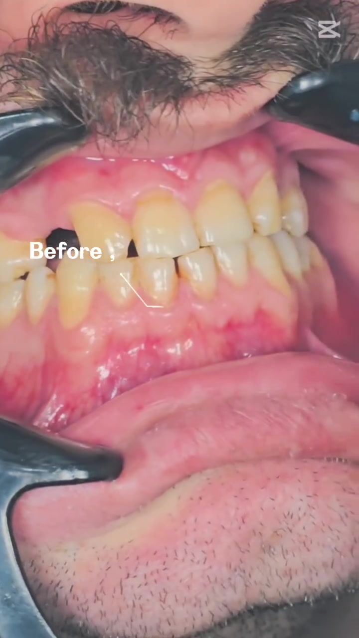 🦷✨ ابتسامتكم تستحق أجمل عناية! ✨🦷

في عيادة الدكتور حيدر الحسناوي لطب الأسنان نهتم بصحة أسنانكم وجمال ابتسامتكم، ونحرص على تقديم الرعاية والاهتمام بكل مراجع، لأن ابتسامتكم عنوان ثقتكم وجمالكم. 🤍

🌟 عنايتكم بأسنانكم تبدأ بخطوة، وابتسامتكم تستحق الاهتمام.

📍 العنوان: كربلاء المقدسة – الهندية – جوار نقابة المعلمين، مقابل مصرف الرافدين.

📞 للحجز والاستفسار:
***********

🦷 عيادة الدكتور حيدر الحسناوي
لأن الابتسامة الجميلة تبدأ بصحة أسنانك.

#عيادة_الدكتور_حيدر_الحسناوي #طب_الأسنان #كربلاء #الهندية #ابتسامتكم_تهمنا
