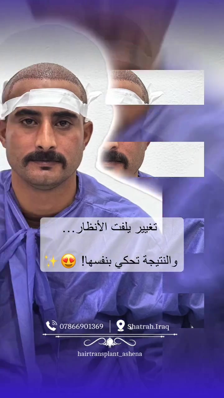 زراعة الشعر • الشطرة ذي قار • قبل وبعد