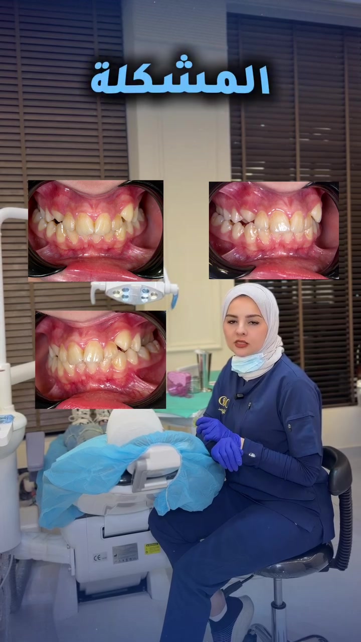 🦷✨ بداية جديدة لابتسامة أجمل
اليوم نشارككم بداية علاج إحدى حالات تقويم الأسنان
مع تركيب جهاز التقويم المتحرك ومتابعة الحالة خطوة بخطوة بإشراف:
الدكتورة سرى أحمد
اختصاص تقويم الأسنان

📍 المبنى الألماني الدولي لطب وتجميل الأسنان
بغداد – البنوك، مجاور جسر البنوك
📞 ***********
📞 ***********
#تقويم_الاسنان #تقويم_اسنان_بغداد #د_سرى_احمد #اختصاص_تقويم #المبنى_الألماني_الدولي

