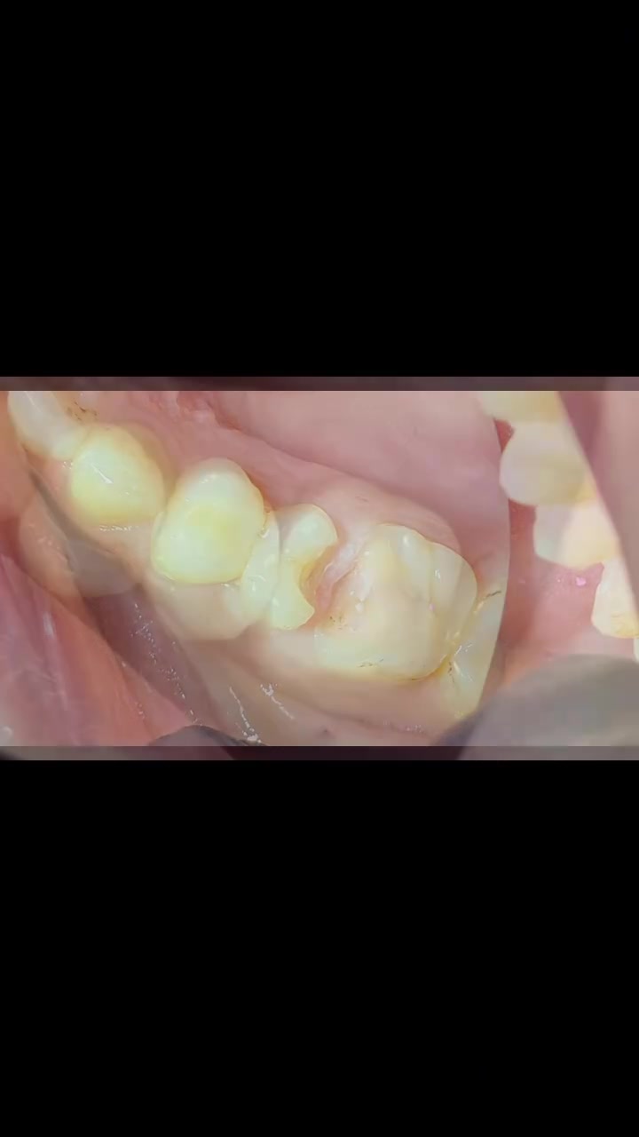 تغير حشوة معدنية معمولة بطريقه خاطئة 
بحشوة ضوئيه تجميلية✨🦷

#عيادة_كوثى_لطب_وتجميل_الاسنان
#الدكتور_علي_حسن_العزاوي 
جبله/نهاية شارع الاطباء
مقابيل الدكتوره ميثاق المعموري

***********//للاستفسار او مراسلة الحساب خاص
