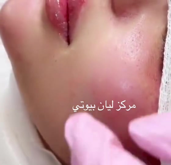 مركز ليان بيوتي اربع شوارع مجاور ازياء بسام القريشي عرض سيسي 50 
للحجز ***********
