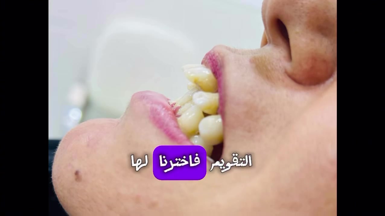‎ لإن كل ابتسامة إلها حلها الخاص، ودورنا نختار الحل الأنسب للحالة، مو مجرد تغيير شكل الأسنان

‎عيادة الدكتور عباس حامد القريشي 
‎ ارقام الحجز :
***********
***********

#dentist 
‎#تجميل 
‎#عيادة_اسنان 
‎#ابتسامة_هوليوود

