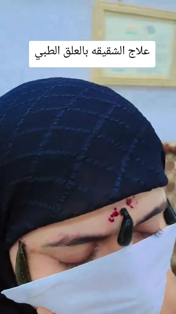 الحجامة النبوية • مساج علاجي • طوريج