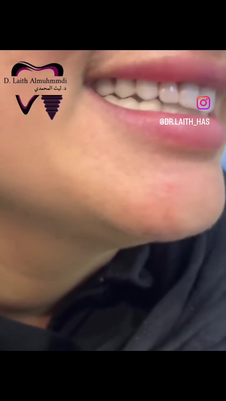 ✨🦷 ابتسامة المشاهير… سر الابتسامة الملفتة 🦷✨
ابتسامة أنيقة، متناسقة ومشرقة تبدأ من هنا 🤍
لابتسامة تمنحك ثقة أكبر وتناسب ملامح وجهك ✨

👨‍⚕️ د. ليث المحمدي
💳 أقساط متوفرة

📍 الجغيفي الثانية – قرب صيدلية المركز – مقابل قاعة الجوهرة

📞 للحجز والاستفسار:
***********
