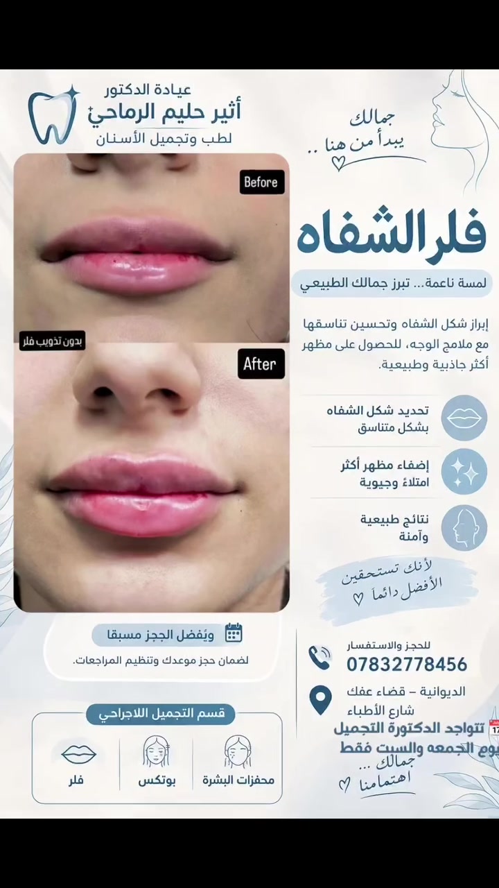 فلر الشفاه • الديوانية عفك • حجز مسبق