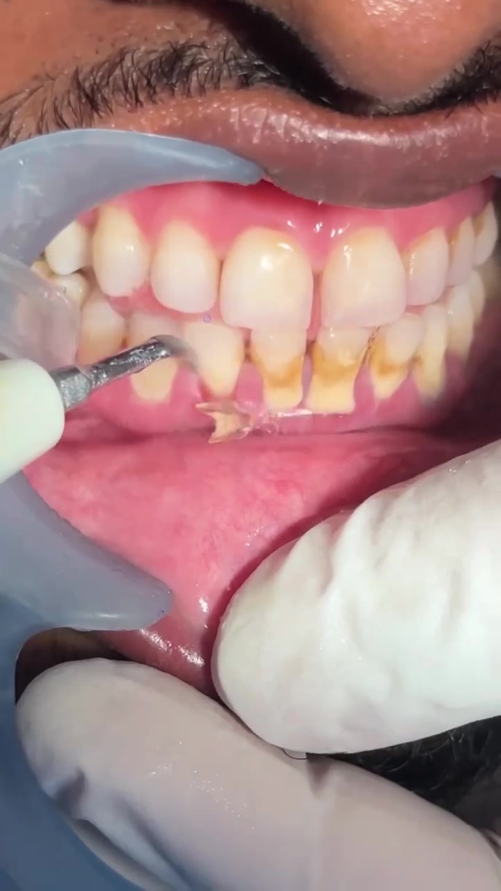 نستقبل مراجعين لإجراء بعض العلاجات مجاناً ✨
🔹 إزالة التكلسات وتنظيف الأسنان
🔹 حشوات الأسنان التجميلية
🔹 علاج تسوس الأسنان
🔹 قلع الأسنان عند الحاجة
🔹 فحص وتشخيص حالة الأسنان واللثة

🤍 الخدمات مجانية لعدد محدود من المراجعين
📌 يتم تحديد نوع العلاج بعد الفحص والتشخيص.

📍 كربلاء – شارع الحر الصغير – جامعة أهل البيت
📞 للحجز والاستفسار واتساب : ***********
