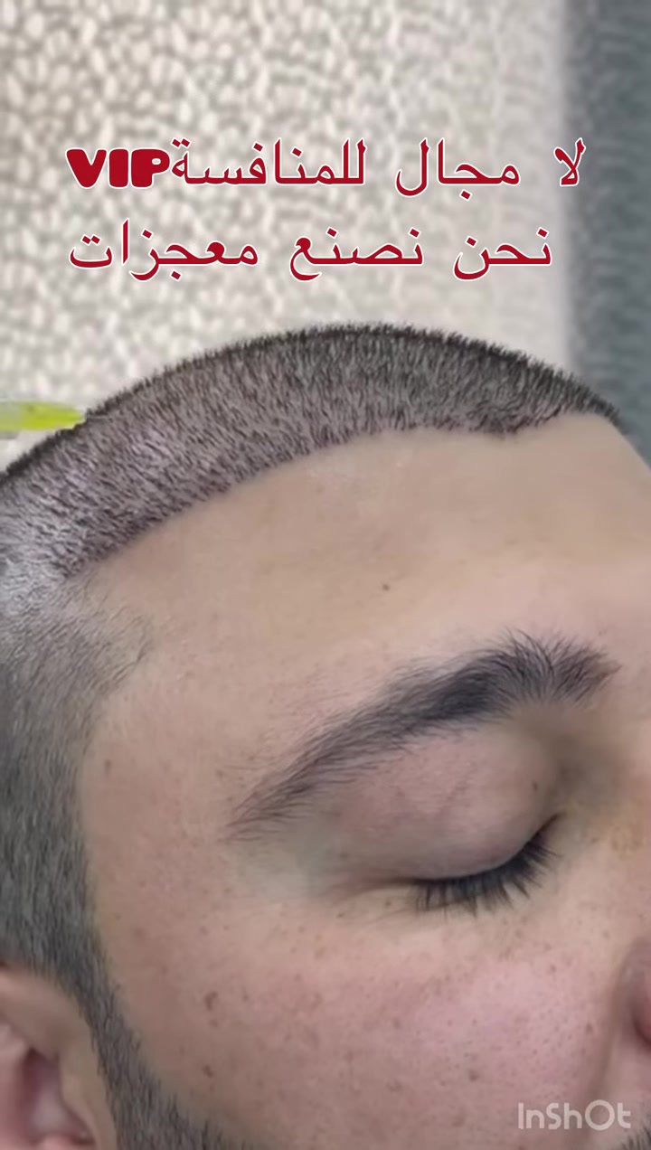 لا مجال للمنافسة!🔥
نحن نصنع معجزات ✍️

مركزنا لزراعة الشعر 
ليس فقط مركزآ بل هو 
علامة فارقة في عالم التجميل الطبي. كل شعرة نزرعها هي شهادة على دقتنا واحترافنا. نجاحنا ليس مجرد نتائج، بل هو فلسفة عمل، تعتمد على أحدث التقنيات، فريق طبي محترف، ورؤية واضحة للمستقبل. من يختارنا لا يختار مجرد حل، بل يختار ضمان النجاح والتميز. في مركزنا، لا نزرع الشعر فقط، بل نزرع ثقة جديدة وحياة أفضل.

Vip📞. Vip📞. Vip📞
 اختيارك المفضل
الادارة *********** واتساب
