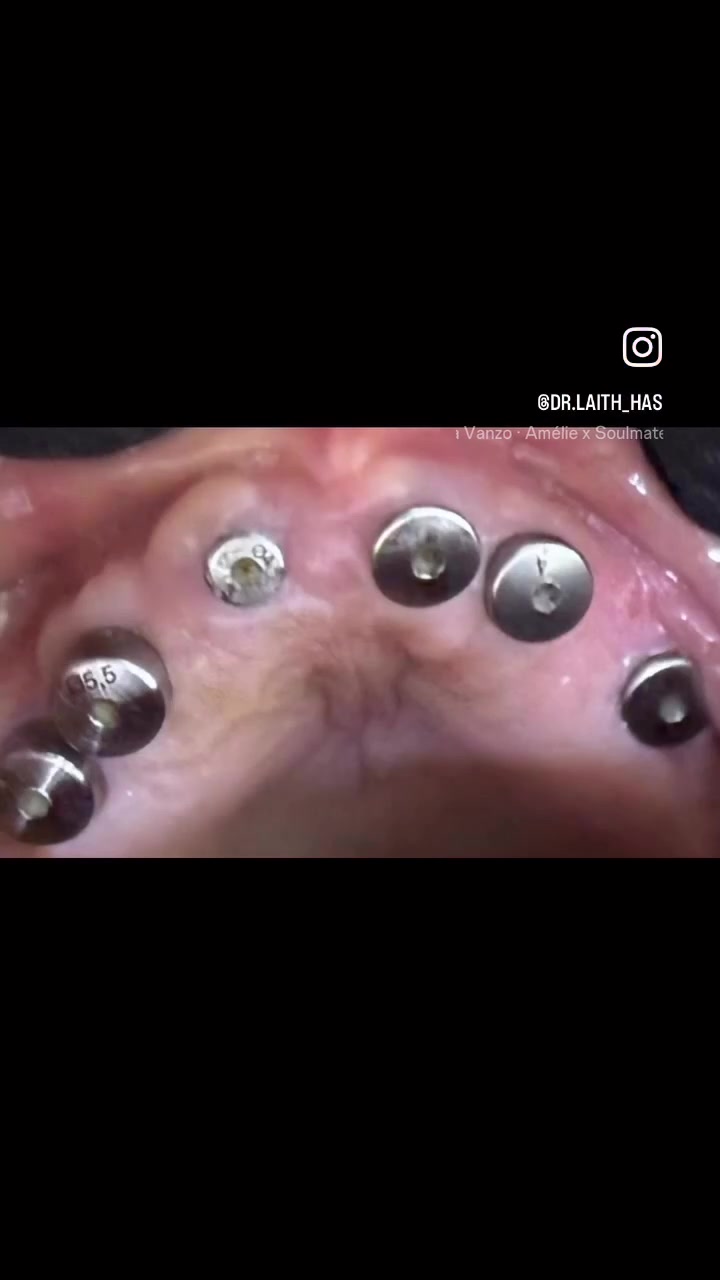 زراعة الأسنان • تجميل الابتسامة • الفلوجة