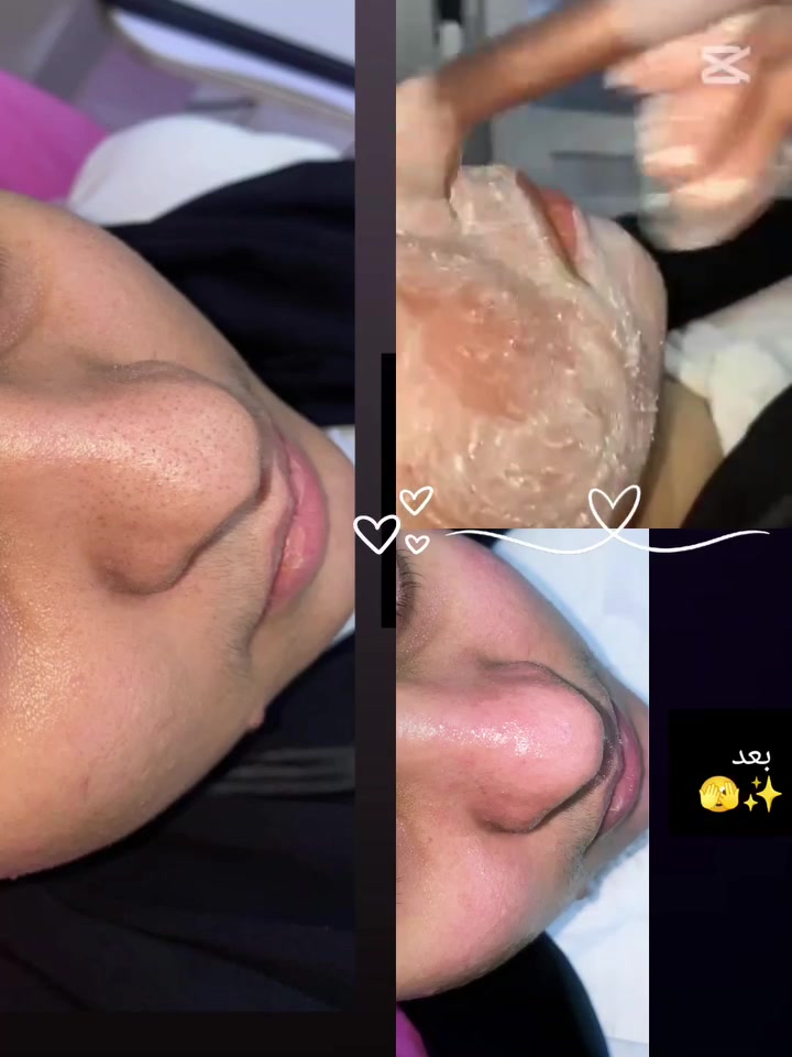 هايدركول • تنظيف عميق • فوتون ضوئي