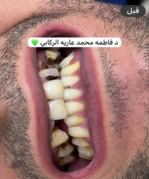 عبد الرحمن من الحالات الي تعاني من الم وتسوس ومدخن واحتاجينا التزام حتى وصلنا لهل ابتسامه دائما لاتخلون اسنانكم توصل لهيج مرحله ويجيبكم الالم جلسه ولا جلستين اثنين ولا اربعه اربعه ولا قلع شي أهون من شي مخسرانين شي الفحص مجاني وتدللون علينا وصحه وعافيه للجميع كحلو عينكم ب نتيجه عبد الرحمن🌸💚 الدكتورتنا الراقية د. فاطمة محمد عارية ♕🦷👑

نص مكتوب في الصور:
- قبل / بعد - تركيبات الزركونيا
- قبل
- بعد
- دكتورة فاطمة محمد عاريه الركابي المعالجه اسنانكم وبشرتكم متواجدة على مدار أيام الأسبوع وحتى يوم الجمعة نخدمتكم شرف لنا
