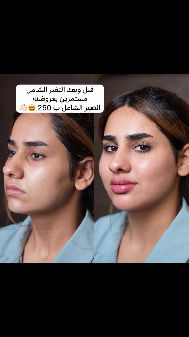 تغير شامل ،😍👌
للحجز والاستفسار *********** #طب #تجميل #مجمع #الشفاء
