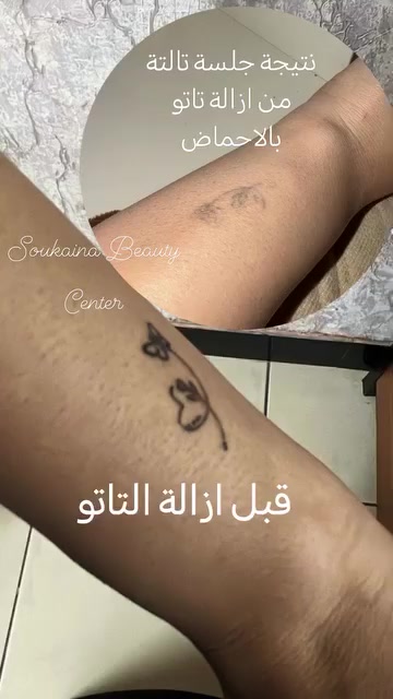 إزالة تاتو • ٣ جلسات • فيريموفل نانو