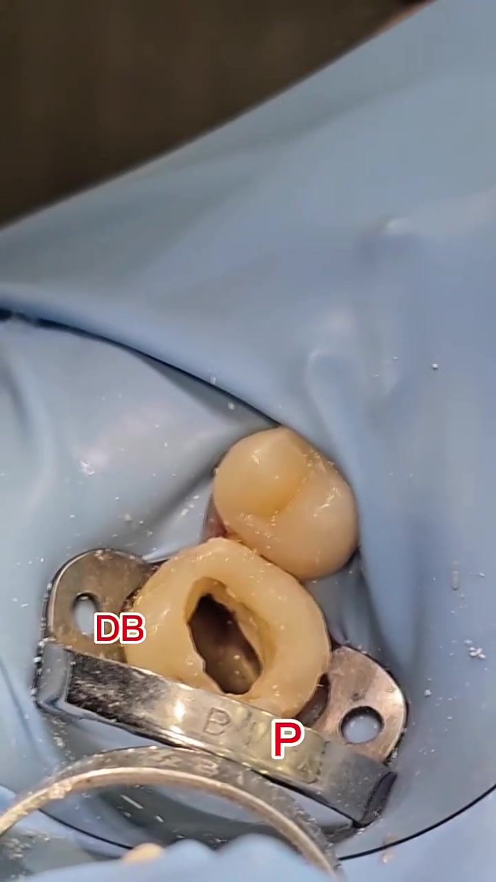 الحشوات التجميلية واعادة بناء شكل الاسنان

عيادة المسك لطب الاسنان✨️👌🏻

📍بغداد – المعامل - الحسينيه - قرب فلكة الشهداء - مجمع المسك الطبي

☎️ للحجز والاستفسار يرجى مراسلة الصفحه أو الاتصال على الرقم التالي ***********
