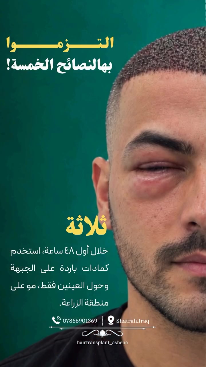 العناية بعد الزراعة • نصائح طبية • الشطرة