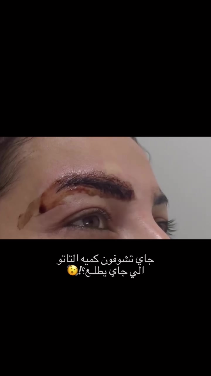 تعبتِ من التاتو القديم ومترددة شلون تتخلصين منه بأمان؟ 

تقنية PhiRemoval لتنظيف وإزالة صبغات التاتو والفايبراوز 

السابقة هي خياركِ المثالي لحل المشكلة من أساسها وبطريقة

 احترافية تماماً.

نعيد لبشرتكِ صحتها ونظافتها بدون ألم قاسي ولا تلف 

للأنسجة، حتى تكونين مرتاحة وواثقة بجمال إطلالتكِ 

💡 بشرتكِ تستحق الأفضل دائماً..

للأستفسار 
***********
 Parween.thestar
