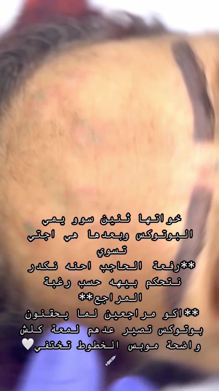 صار هواي ممنزلتلكم رڤيوات مراجعاتي بسبب اللود 🤍💉
العروض مستمره اسبوع وتخلص 🤍💉 
بهاي العروض تكدرين تسوين تغيير شامل 
+ جلسات نضاره فري تحصلين 

💉ماشاءالله الاسبوع الي فات اقبال المراجعات على البوتوكس بشكل كبير 🤍💉

للحجز والاستفسار 
واتساب***********

او دايركت مسج فيسبوك DrRusl Alrubaie
او انستكرام

https://www.instagram.com/p/DbWWdUhsNAt/?stkn=Z2EwenVjcm5rOXFu
