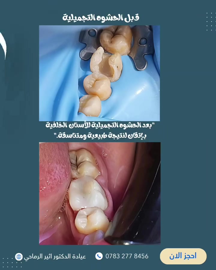 لأن التفاصيل الصغيرة تصنع فرقًا كبيرًا في صحة وجمال الابتسامة. ✨

تم إجراء الحشوات التجميلية للأسنان الخلفية بإتقان واهتمام بالتفاصيل، لاستعادة شكل السن ووظيفته مع الحفاظ على مظهر طبيعي ومتناسق. 🤍

 (عيادة الدكتور أثير حليم الرماحي) 

☎️ للحجز والاستفسار ***********
او مراسلة الصفحة

📍 الموقع: 
الديوانية- قضاء عفك/شارع الأطباء قرب صيدلية أكرم البديري بناية الدكتور مهند علي الجبوري الطابق الثاني

#ابتسامتك_تستحق_الأفضل👌❤️
#حشوات_تجميلية_حشوات_جذور_تركيب_اسنان_ثابتة_ومتحركة_تبييض_اسنان_بالليزر_ابتسامة_المشاهير #اكسبلورexplore
 #قضاء_عفك #حشوات_تجميليه_حشوات_جذر_قلع_جراحي_تركيب_اسنان

