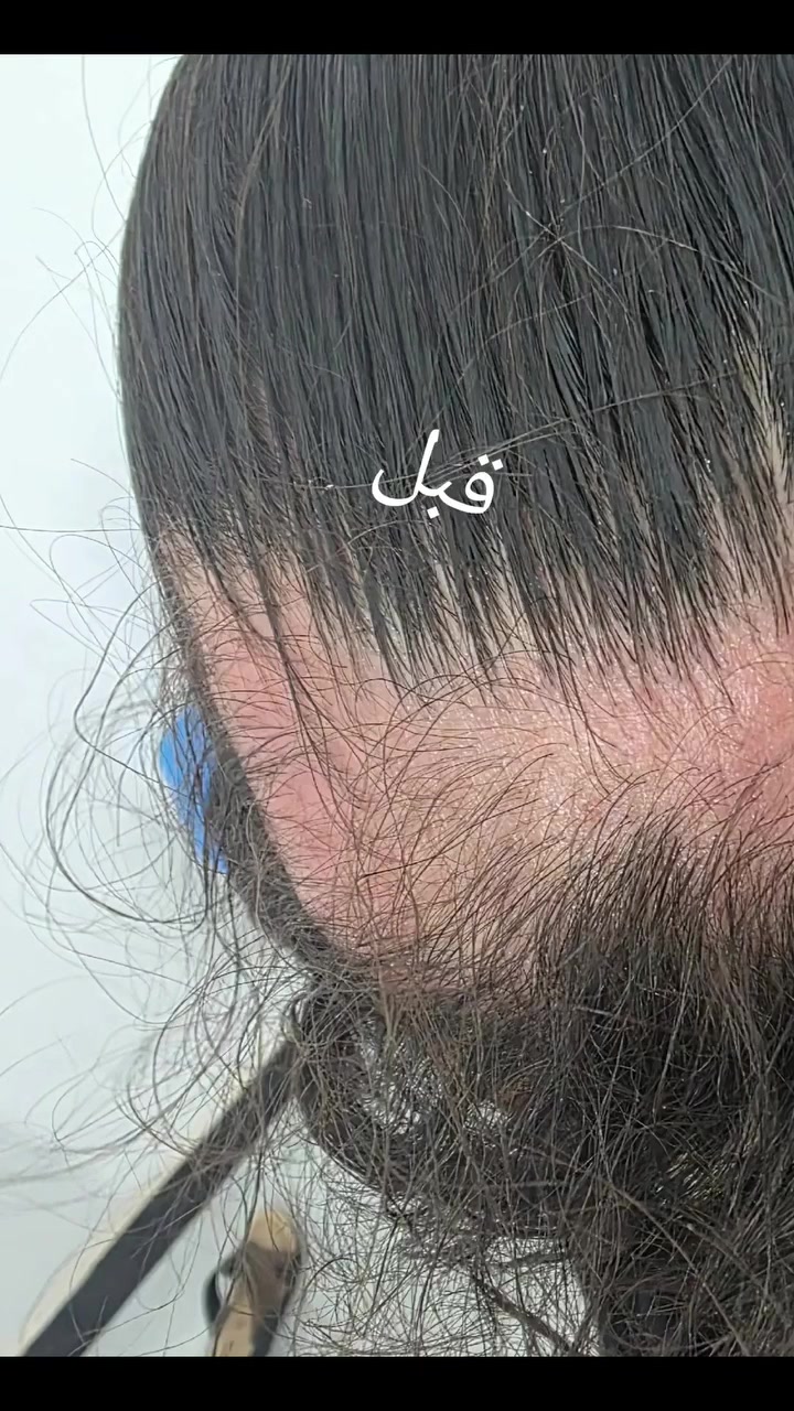 مراجعتنا بعمر ٢٨ سنة كانت تعاني من فراغات واضحة وتساقط ملحوظ في الشعر، وبعد تقييم الحالة ووضع خطة علاجية مناسبة ومتابعة مستمرة، بدأنا نلاحظ تحسناً واضحاً في كثافة الشعر ومظهر فروة الرأس.
📌 النتيجة بعد شهر ونصف فقط من العلاج كانت كما تشاهدون أمامكم 👆🏻
والأجمل أن هذه النتيجة ما زالت في بدايتها، مع استمرار الخطة العلاجية والمتابعة للوصول إلى أفضل كثافة ونمو ممكن للشعر بإذن الله. 🌿✨
د.ساره الجبوري 
الديوانية / عفك / شارع الاطباء / داخل مجمع د.زهراء ناصر الغرابي للسونار
***********
