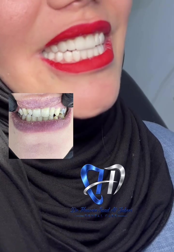 ابتسامة طبيعية • تجميل أسنان • المحمودية