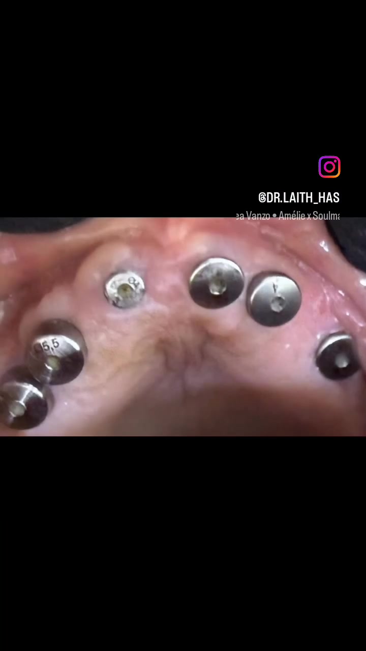 🦷✨ زراعة الأسنان… ابتسامة جديدة بدون ألم وبأسعار مناسبة!
فقدان الأسنان ما عاد مشكلة، استرجع ابتسامتك وثقتك بنفسك مع زراعة الأسنان بأحدث الطرق ✨

والأجمل؟ 🤍
💳 زراعة الأسنان متوفرة بالتقسيط
حتى تقدر تبدأ علاجك وتدفع براحة وبأقساط مناسبة.

✔️ مظهر طبيعي
✔️ ثبات وقوة
✔️ راحة أثناء الأكل والكلام
✔️ نتائج طويلة الأمد

📍 مركز الدكتور ليث المحمدي
الفلوجة – الجغيفي الثانية، قرب الصيدلية المركزية، مقابل قاعة الجوهرة
📞 ***********
