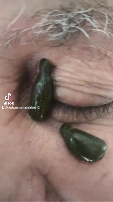 🩸🌿 العلاج بالعلق الطبي... عناية طبيعية بإشراف واهتمام 🌿🩸
✨ يُستخدم العلاج بالعلق الطبي في بعض التطبيقات الطبية، ومنها:
🔹 المساعدة في تحسين تدفق الدم الموضعي
🔹 بعض حالات الاحتقان الوريدي والقدم السكري
🔹 بعض مشكلات الدورة الدموية الموضعية في الوجه وكذالك لاغراض التجميل 
🔹 المساعدة في تخفيف بعض الآلام وعلاج الاعصاب والجيوب الانفية وامراض العين ك ارتفاع ضغط العين وعلاج العصب البصري والعصب الخامس والسابع والعصب الحائر 

🩸 جلسات بالعلق الطبي
🌿 اهتمام بالنظافة وسلامة المراجع
📞 للحجز والاستفسار: ***********
📍 ديالى – بعقوبة – المفرك – معشب الزيتوني
