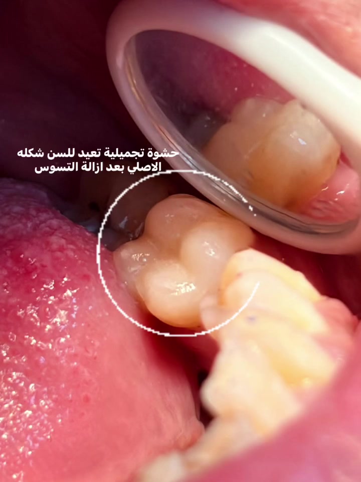 خدمات مجانية • الجامعة المستنصرية • قلع أسنان