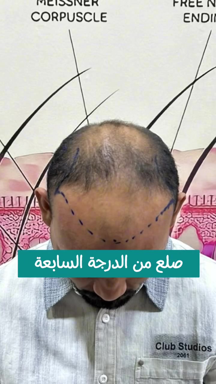 زراعة شعر • اقساط شهرية • ضمان مدى الحياة