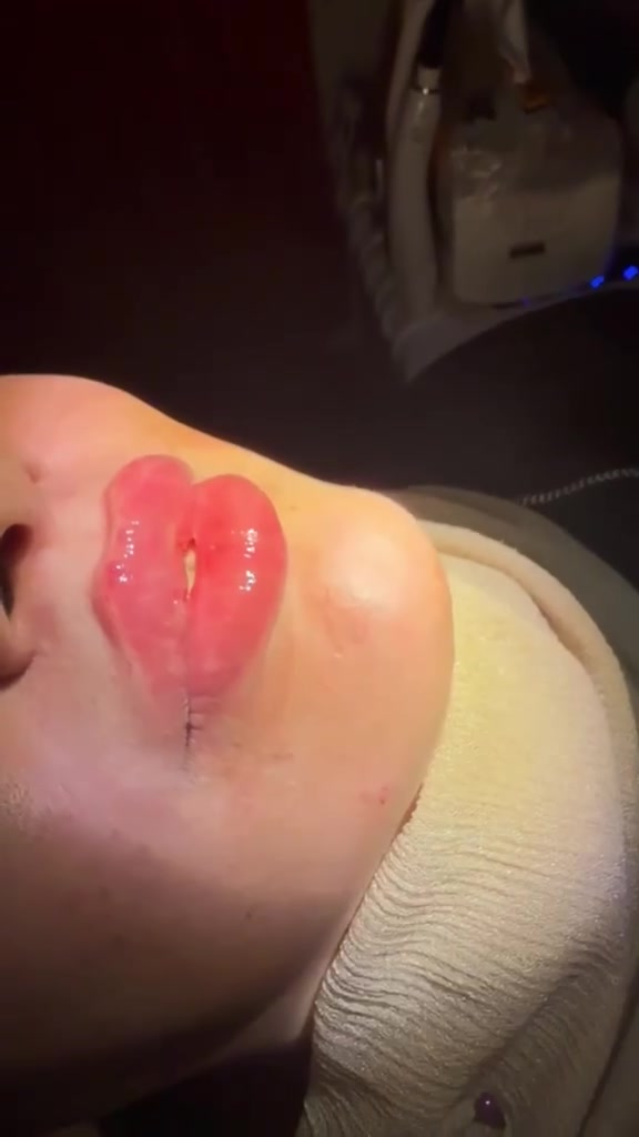 عيادة 4u ⬇️ 
توازن ،امتلاء ، واناقه في التفاصيل 👄 
فيلر الشفاه يمنحك مظهراً طبيعياً ناعماً يبرز جمالك الحقيقي ✨ 

* عروض الفيلر :  
🔸فيلر الكوري 👈🏼 ب 30 الف فقط 
🔸فيلر كوري براند 👈🏼 ب ٥٠ الف 
🔸 فلر امريكي 👈🏼 75 الف 
🔸 فلر اسباني 👈🏼 100 الف 
🔸 فلر فرنسي 👈🏼 80 الف ⁠

* عروض البوتكس : 
🔸بوتكس الجبهه وجوانب العين 👈🏼75 الف 
🔸 بوتكس ابتسامه اللثويه 👈🏼 40 الف 
🔸 بوتكس كامل الوجه 👈🏼 100 الف 
🔸 بوتكس التعرق 👈🏼 100 الف 

اسعارنا  تنافسيه 🔥 💵 
تحت اشراف الدكتوره  (ايه معن ) جمالك يستحق لمسه احترافيه في عيادة  4u  
العنوان / الخطيب الزراعي _ شارع خوله _ قرب صيدليه قدوري  
للحجز والاستفسار  ( *********** )
