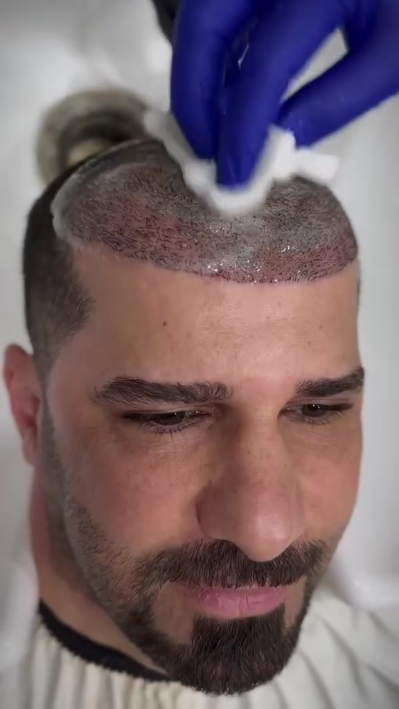 نتيجه ١٥ يوم فقط
 غسله التقشير من بعد اجراء زراعه الشعر 🩵✔️
مانحتك ضعيفة؟ 
وگالولك مستحيل تنزرع بجلسة وحدة؟

لا تستعجل وتدفع كلفة جلستين قبل ما تعرف رأي الكادر الطبي المختص .

🔻بمركز المنصور، الحالات اللي غير مراكز تعتبرها صعبة أو تحتاج أكثر من جلسة، 
عدنا إلها حلول مدروسة 
بفضل خبرتنا الكبيرة بزراعة الشعر للحالات ذات المانحة الضعيفة.

ليش تدفع مرتين وتنتظر مرتين إذا ممكن تحصل على النتيجة بجلسة وحدة؟

شوف بنفسك الحالات والنتائج الحقيقية، واعرف ليش مركز المنصور صار الوجهة الأولى لأصحاب المانحات الضعيفة والصلع الواسع.

✅ اختصاص المانحات الضعيفة
✅ استغلال أمثل للمنطقة المانحة
✅ كثافة طبيعية وخط جبهة مدروس
✅ آلاف العمليات الناجحة

المكان اللي يحوّل أصعب الحالات إلى قصص نجاح. �

زورنا لموقع العياده
بغداد المنصور شارع الرواد مقابل مرطبات مشمشه
او الاتصال
***********
