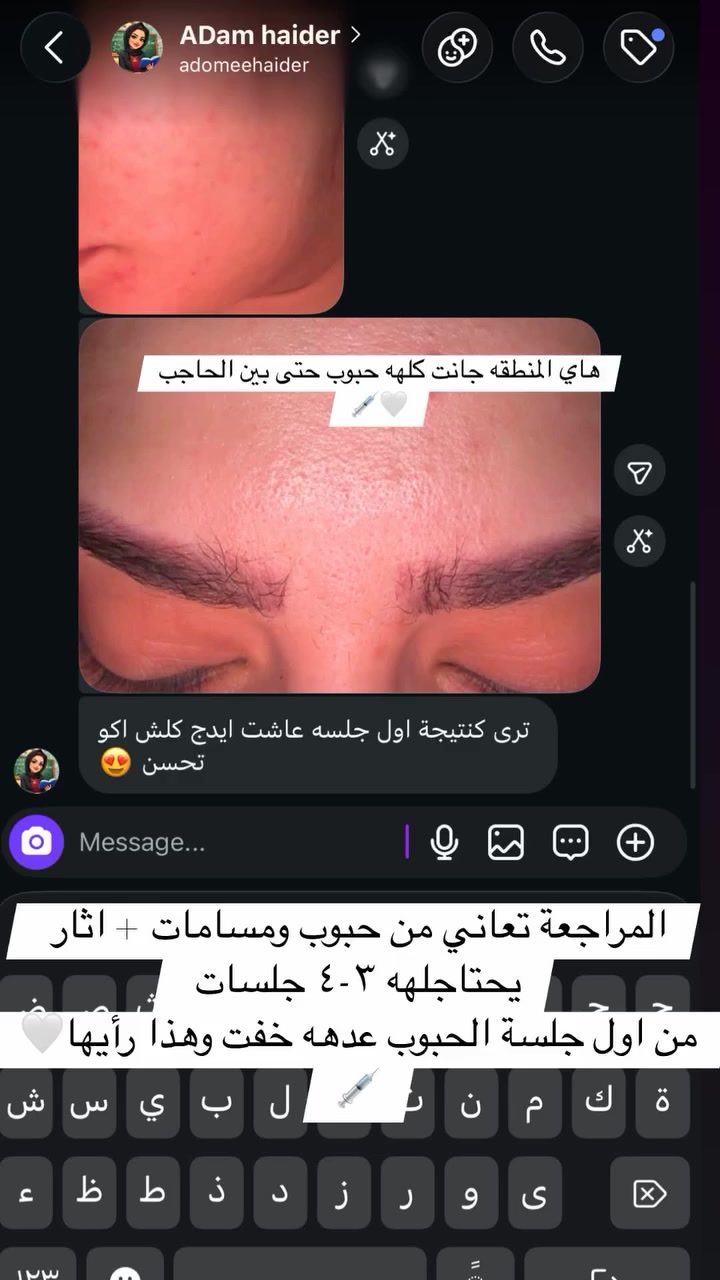 تجارب المراجعات صوت وصورة💗🍒💉
حاليا مسويتلكم اقوى العرض ومستحيل تتكرر بعد هاي العروض لان بفترة قصيرة بالمسيب حققنا نجاح الحمدلله وصارو مراجعينا هواي ويطلبون من عدنا عروض 💗💉🍒💯 

*****العروض هاي قوية وفقط هذا الشهر مراح تتكرر ابداً*****

ممكن بعدين نسوي غير عروض بس مثل هاي متتكرر💗

للاستفسار عن العروض واسعار الفلر البراند حصراً 

وابر النضاره اما دايركت مسج 

او https://www.instagram.com/p/Dc8uh21sHun/?stkn=cmpyejkwZ2EwcjAy

او واتساب مسج ***********

المسيب شارع البلدية

💗💉

— في ‏المسيب‏.

