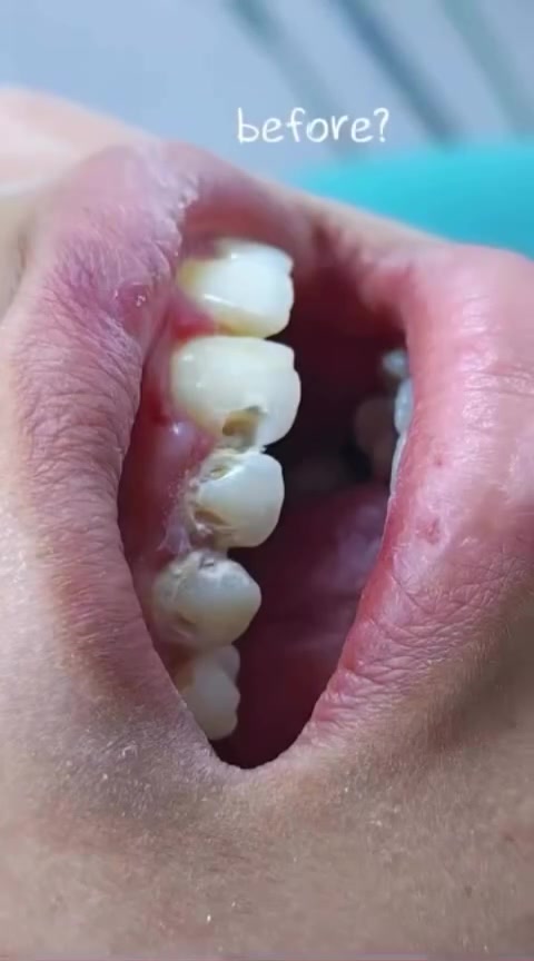 الحشوات التجميليه في عيادة الدكتور حسنين الطائي 
الديوانية الجلبية قرب جامع القائم ***********
#عيادة #طب_اسنان

