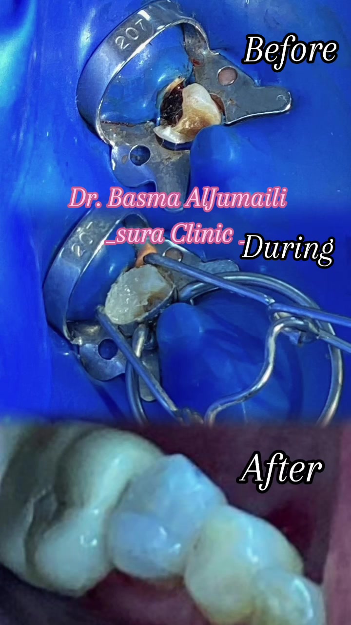سلام عليكم ورحمة الله وبركاته
✨ فرصة مميزة لعلاج أسنانك بأسعار رمزية 🦷
طبيبة أسنان حاصلة على عدة شهادات ودورات تدريبية في مجال طب الأسنان، تقدم خدمات علاجية لمختلف الحالات بأسعار رمزية تصل إلى نصف السعر.
🔹 يشمل استقبال مختلف الحالات السنية
🔹 أسعار مناسبة ومخفضة
🔹 يتم توثيق ودراسة كل حالة ضمن بحث علمي بهدف تطوير الخبرة والجانب العلمي والسريري.
🔷 بيئه آمنه ومعقمه لكل مراجع ادوات خاصه به يتم التخلص منها بعد انتهاء الجلسه. 
📍 للحجز والاستفسار:
📱 واتساب: ***********

العلاج بامانه تامه ويوجد كارت ضمان مع تقرير كامل لحالة كل مريض وتتوفر صور لحالات علاجية من شغلنا على صفحتي الخاصه 📸
